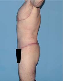Body Contouring After Photo by Siamak Agha, MD PhD FACS; Newport Beach, CA - Case 44031