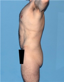 Body Contouring Before Photo by Siamak Agha, MD PhD FACS; Newport Beach, CA - Case 44031