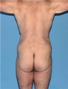 Body Contouring Before Photo by Siamak Agha, MD PhD FACS; Newport Beach, CA - Case 44031