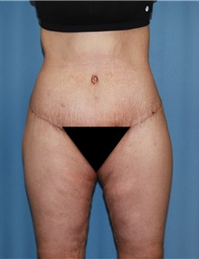 Body Contouring After Photo by Siamak Agha, MD; Newport Beach, CA - Case 44038
