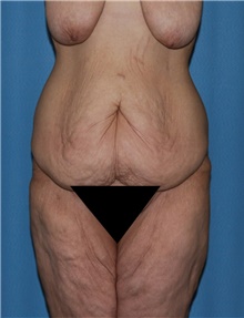 Body Contouring Before Photo by Siamak Agha, MD; Newport Beach, CA - Case 44038