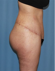 Body Contouring After Photo by Siamak Agha, MD PhD FACS; Newport Beach, CA - Case 44038