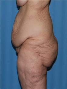 Body Contouring Before Photo by Siamak Agha, MD PhD FACS; Newport Beach, CA - Case 44038