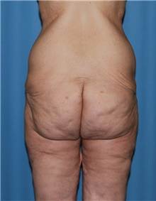 Body Contouring Before Photo by Siamak Agha, MD PhD FACS; Newport Beach, CA - Case 44038