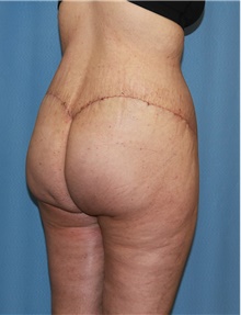 Body Contouring After Photo by Siamak Agha, MD PhD FACS; Newport Beach, CA - Case 44038