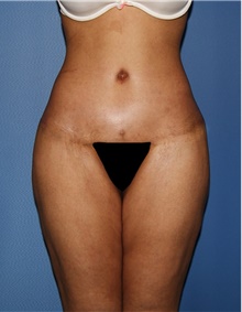 Body Contouring After Photo by Siamak Agha, MD; Newport Beach, CA - Case 44039