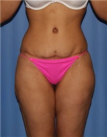 Body Contouring Before Photo by Siamak Agha, MD; Newport Beach, CA - Case 44039