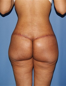 Body Contouring After Photo by Siamak Agha, MD PhD FACS; Newport Beach, CA - Case 44039