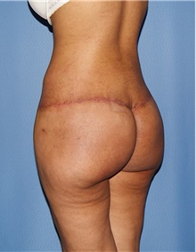 Body Contouring After Photo by Siamak Agha, MD PhD FACS; Newport Beach, CA - Case 44039