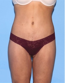 Body Contouring After Photo by Siamak Agha, MD; Newport Beach, CA - Case 44040