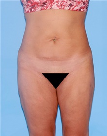 Body Contouring Before Photo by Siamak Agha, MD; Newport Beach, CA - Case 44040