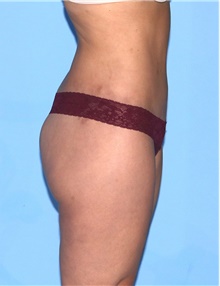 Body Contouring After Photo by Siamak Agha, MD PhD FACS; Newport Beach, CA - Case 44040