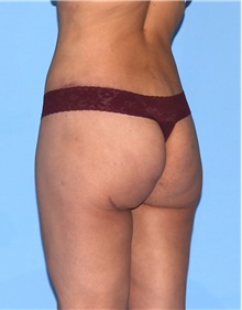 Body Contouring After Photo by Siamak Agha, MD PhD FACS; Newport Beach, CA - Case 44040