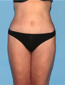 Body Contouring After Photo by Siamak Agha, MD; Newport Beach, CA - Case 44044