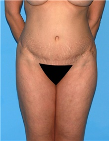 Body Contouring Before Photo by Siamak Agha, MD; Newport Beach, CA - Case 44044