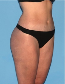 Body Contouring After Photo by Siamak Agha, MD PhD FACS; Newport Beach, CA - Case 44044