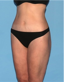 Body Contouring After Photo by Siamak Agha, MD PhD FACS; Newport Beach, CA - Case 44044