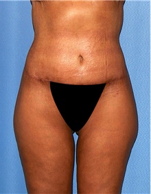Body Contouring After Photo by Siamak Agha, MD PhD FACS; Newport Beach, CA - Case 44045