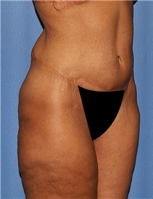 Body Contouring Before Photo by Siamak Agha, MD PhD FACS; Newport Beach, CA - Case 44045