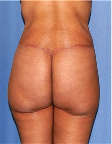 Body Contouring After Photo by Siamak Agha, MD PhD FACS; Newport Beach, CA - Case 44045