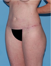 Body Contouring After Photo by Siamak Agha, MD PhD FACS; Newport Beach, CA - Case 44046