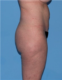 Body Contouring Before Photo by Siamak Agha, MD PhD FACS; Newport Beach, CA - Case 44046