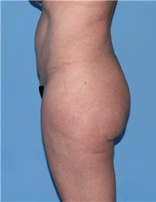 Body Contouring Before Photo by Siamak Agha, MD PhD FACS; Newport Beach, CA - Case 44046