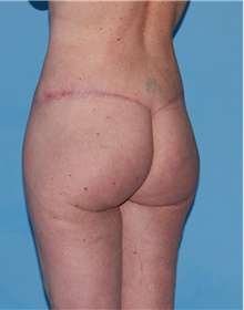 Body Contouring After Photo by Siamak Agha, MD PhD FACS; Newport Beach, CA - Case 44046