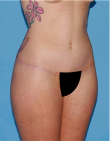 Body Contouring After Photo by Siamak Agha, MD PhD FACS; Newport Beach, CA - Case 44047