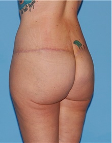 Body Contouring After Photo by Siamak Agha, MD PhD FACS; Newport Beach, CA - Case 44047