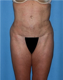 Body Contouring Before Photo by Siamak Agha, MD PhD FACS; Newport Beach, CA - Case 44048