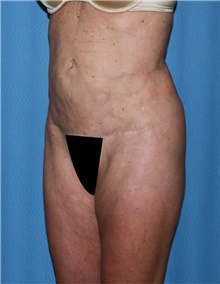 Body Contouring Before Photo by Siamak Agha, MD PhD FACS; Newport Beach, CA - Case 44048