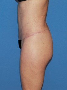 Body Contouring After Photo by Siamak Agha, MD PhD FACS; Newport Beach, CA - Case 44048