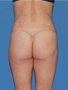 Body Contouring After Photo by Siamak Agha, MD PhD FACS; Newport Beach, CA - Case 44048