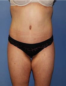 Body Contouring After Photo by Siamak Agha, MD; Newport Beach, CA - Case 44050