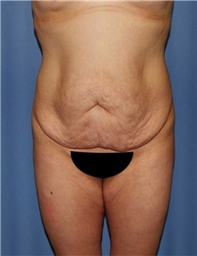 Body Contouring Before Photo by Siamak Agha, MD PhD FACS; Newport Beach, CA - Case 44050