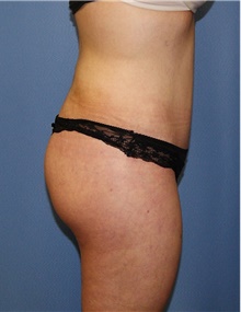 Body Contouring After Photo by Siamak Agha, MD PhD FACS; Newport Beach, CA - Case 44050