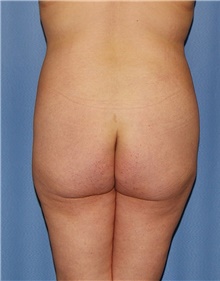 Body Contouring Before Photo by Siamak Agha, MD PhD FACS; Newport Beach, CA - Case 44050