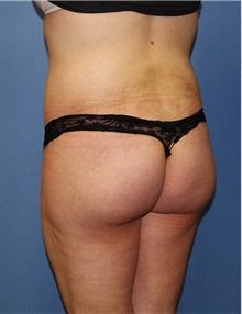 Body Contouring After Photo by Siamak Agha, MD PhD FACS; Newport Beach, CA - Case 44050