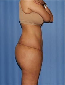 Body Contouring After Photo by Siamak Agha, MD PhD FACS; Newport Beach, CA - Case 44051