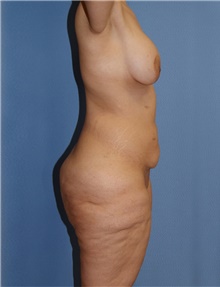 Body Contouring Before Photo by Siamak Agha, MD PhD FACS; Newport Beach, CA - Case 44051