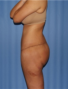 Body Contouring After Photo by Siamak Agha, MD PhD FACS; Newport Beach, CA - Case 44051