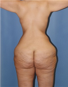 Body Contouring Before Photo by Siamak Agha, MD PhD FACS; Newport Beach, CA - Case 44051