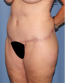 Body Contouring After Photo by Siamak Agha, MD PhD FACS; Newport Beach, CA - Case 44053