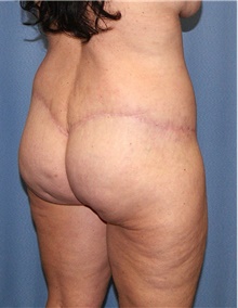 Body Contouring After Photo by Siamak Agha, MD PhD FACS; Newport Beach, CA - Case 44053