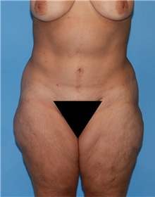 Body Contouring Before Photo by Siamak Agha, MD PhD FACS; Newport Beach, CA - Case 44055