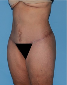 Body Contouring After Photo by Siamak Agha, MD PhD FACS; Newport Beach, CA - Case 44055