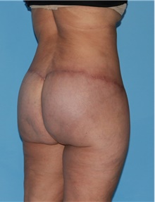 Body Contouring After Photo by Siamak Agha, MD PhD FACS; Newport Beach, CA - Case 44055