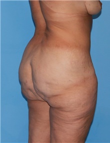 Body Contouring Before Photo by Siamak Agha, MD PhD FACS; Newport Beach, CA - Case 44055