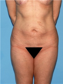 Body Contouring Before Photo by Siamak Agha, MD; Newport Beach, CA - Case 44058